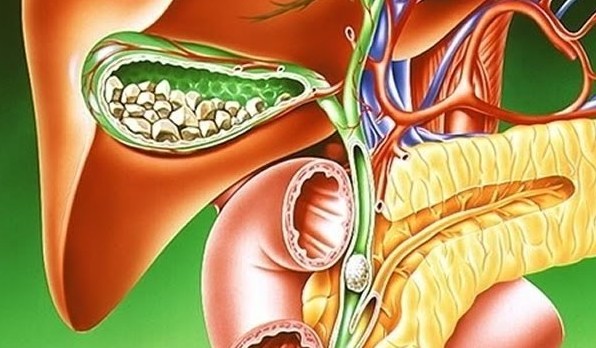 zhelchnokamennaia bolezn